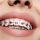 How Braces And Aligners Can Help You