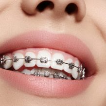 How Braces And Aligners Can Help You